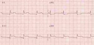 ECG showing evidence of heart disease